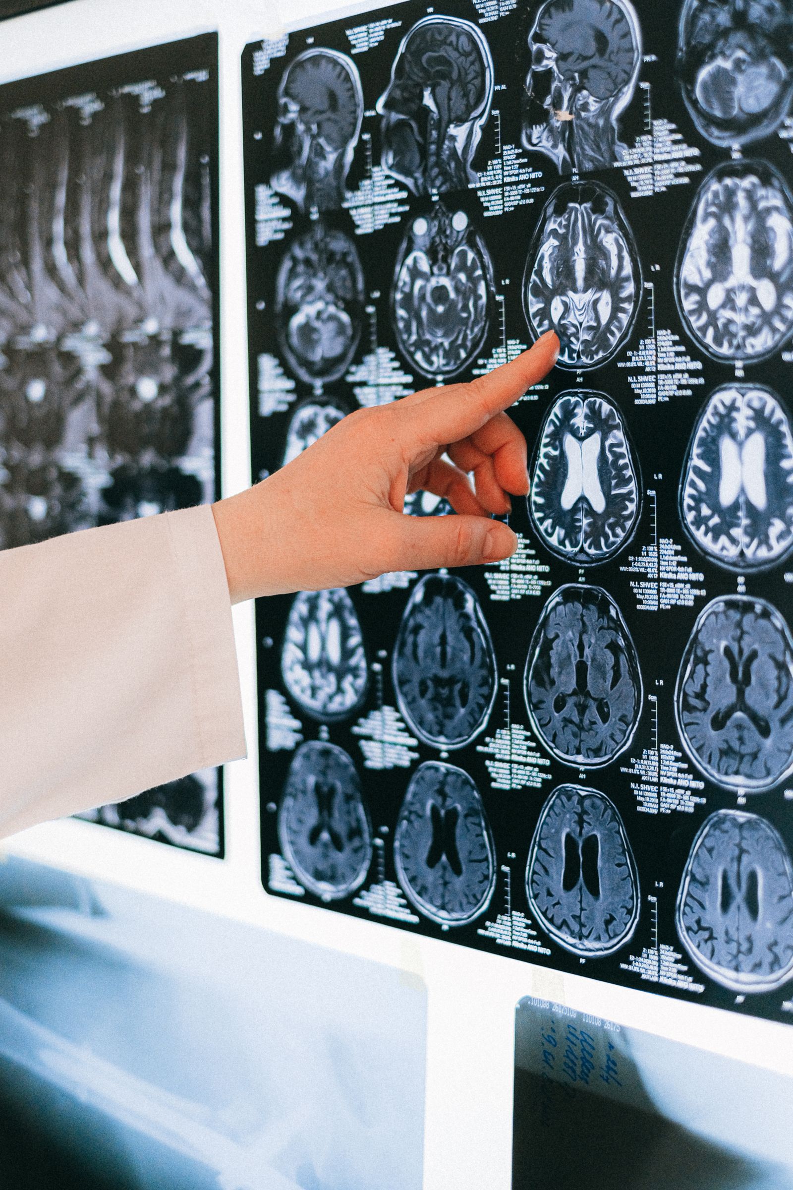 A doctor points at a specific region of interest on a brain MRI film